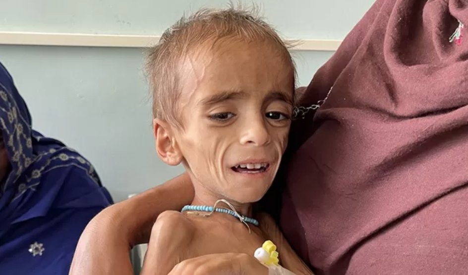 영양실조로 실려온 아이 [출처=BBC뉴스]